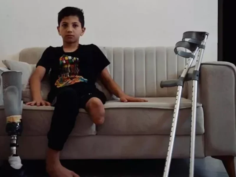 A photo of a child missing a leg after an Israeli attack