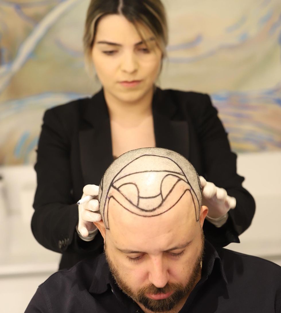A photo of a man in preparation for a Hair transplant surgery.