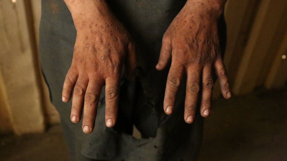 A scrap worker named Anwar has worked outside Bagram airfield, formerly America’s largest military base in Afghanistan, for eight years. He has had a rash on his hands for six years and believes it is caused by his work.​