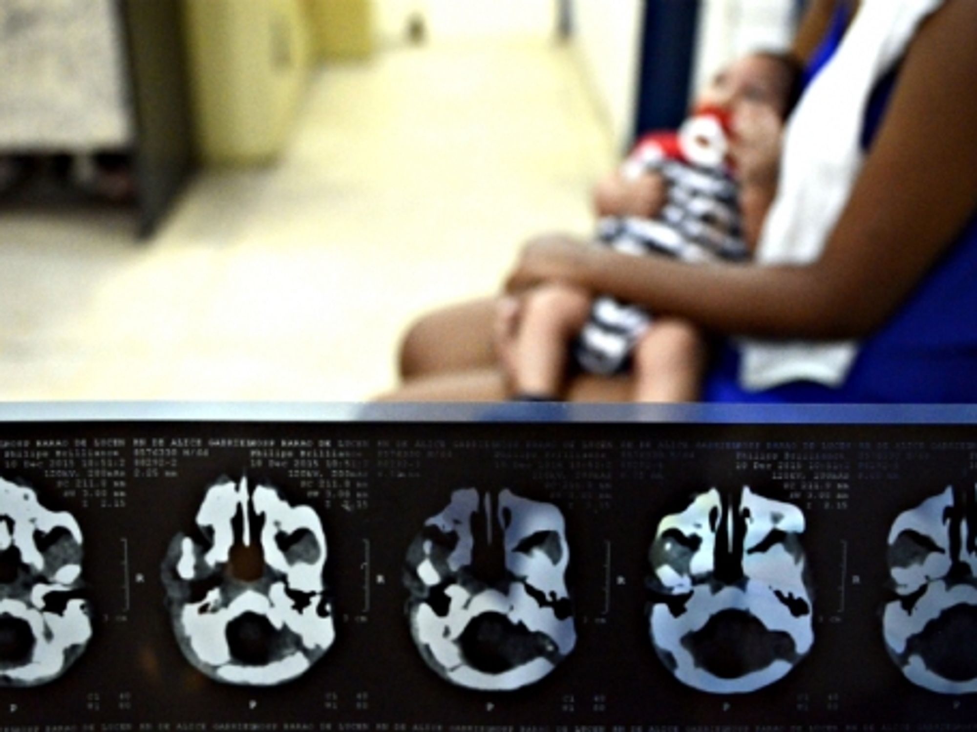 Baby suffering from microcephaly in Recife, Brazil, on Feb. 2