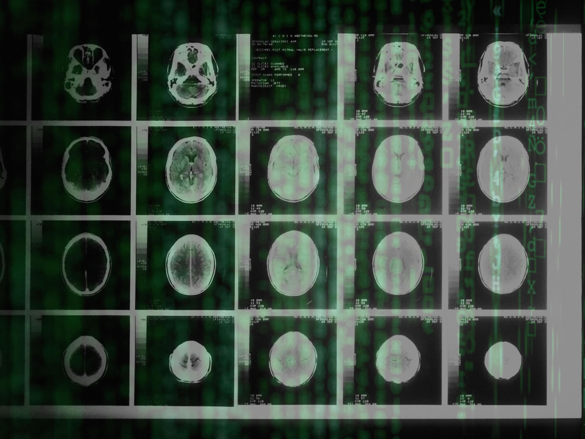 brain MRI