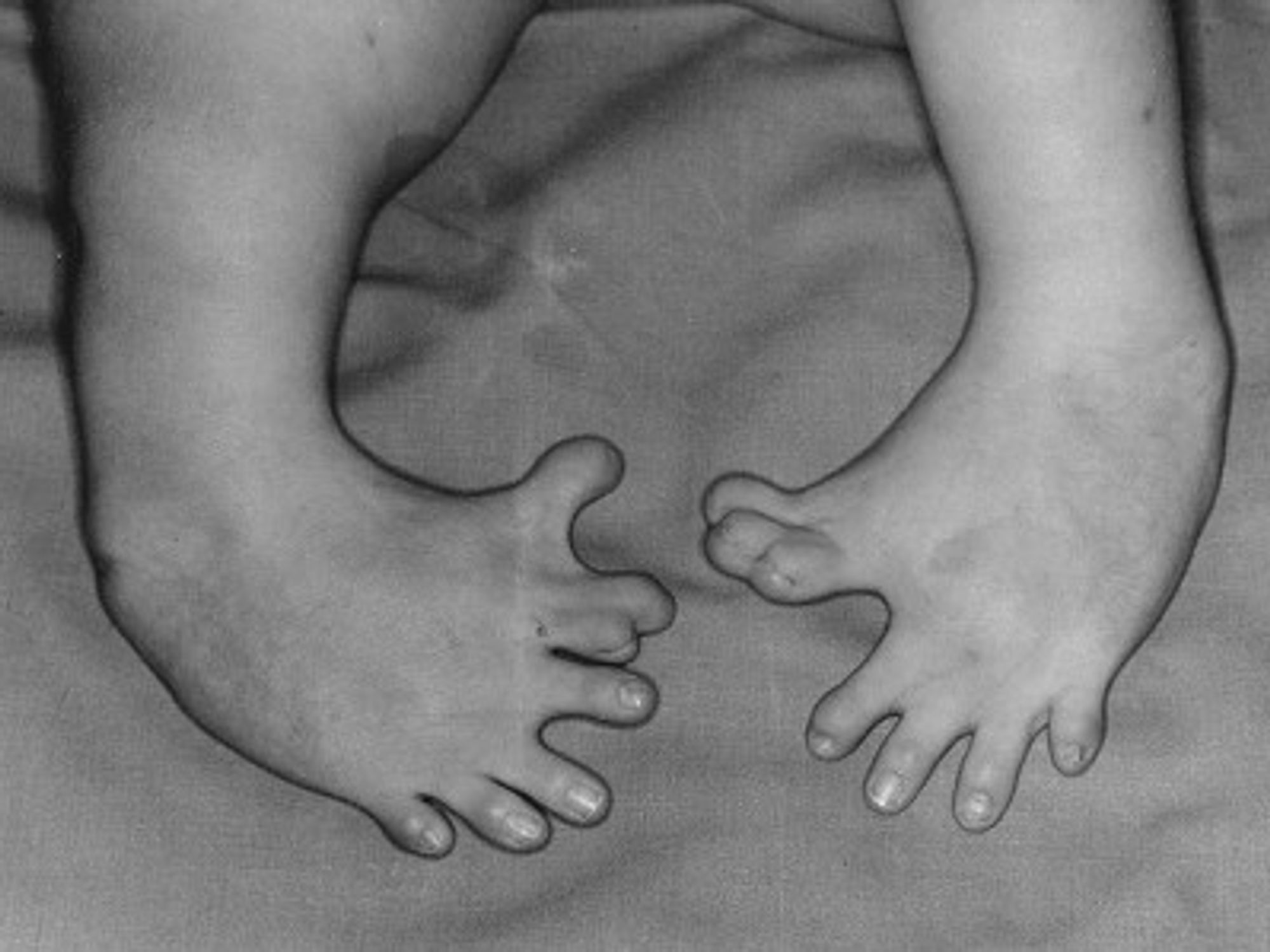 Congenital malformation of the feet caused by maternal drugs like thalidomide (Otisarchives3)
