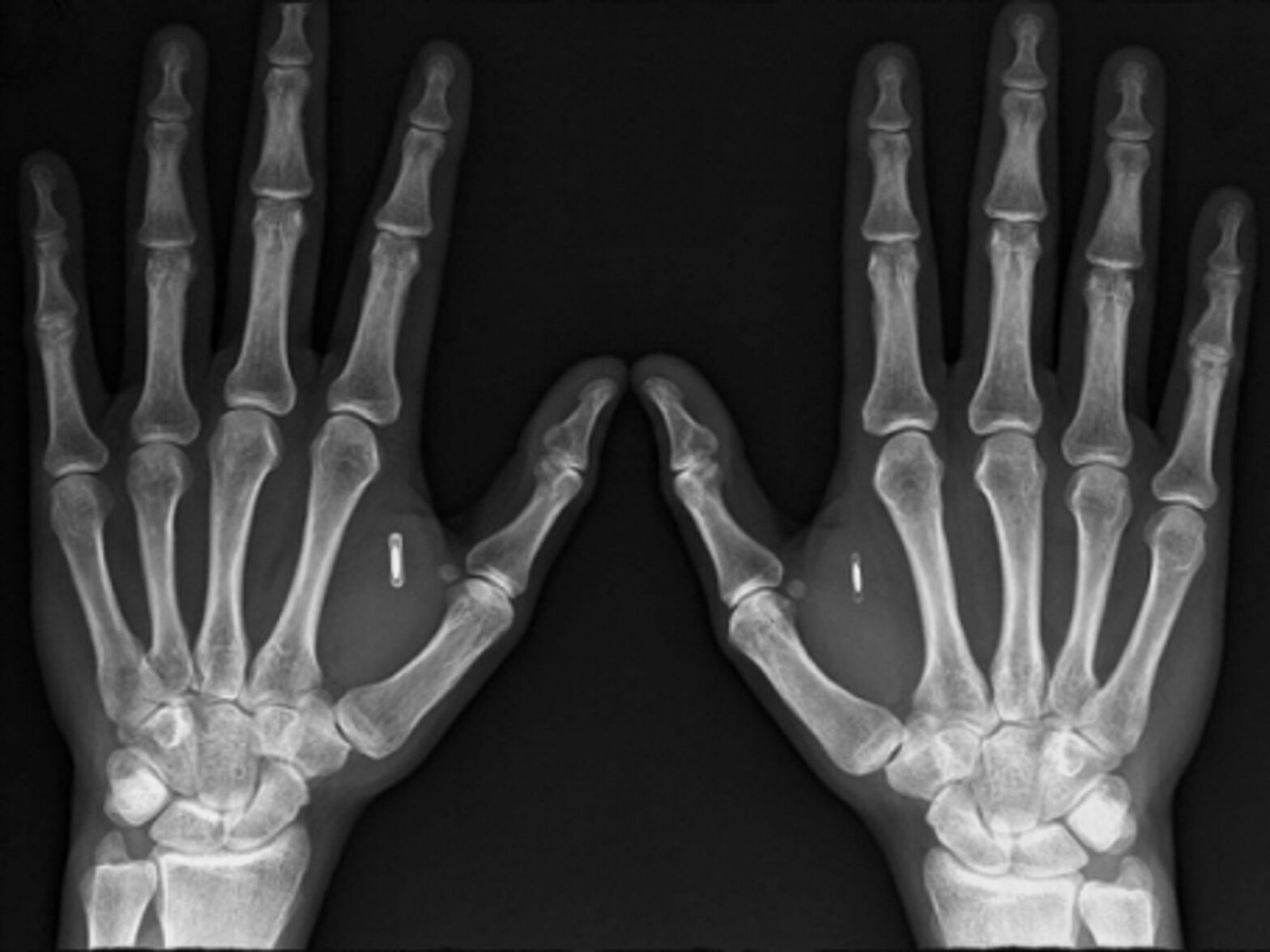 DangeroursThings founder Amal Graafstra's hands ... and microchips