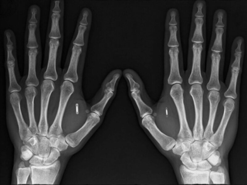DangeroursThings founder Amal Graafstra's hands ... and microchips