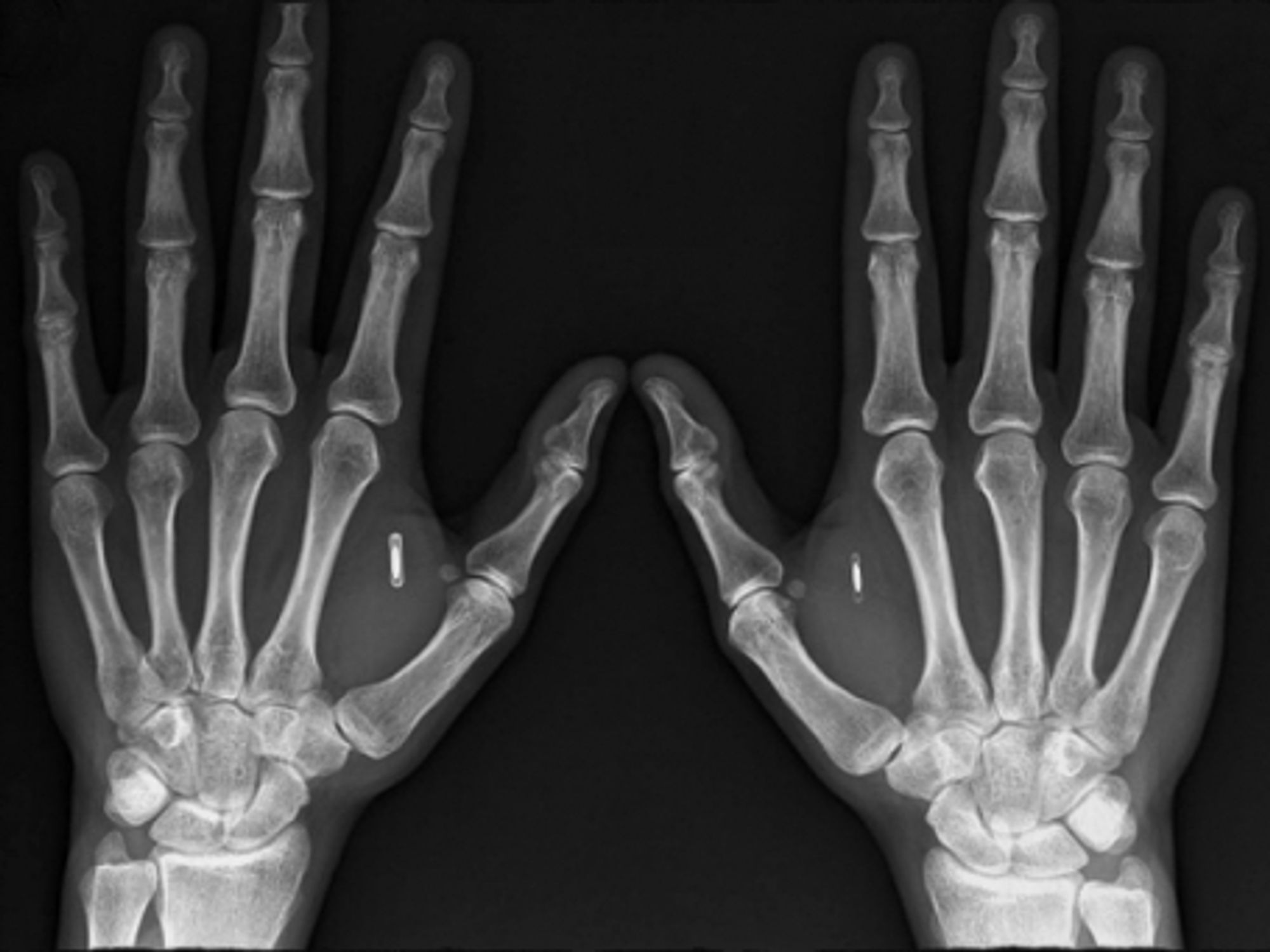 DangeroursThings founder Amal Graafstra's hands ... and microchips