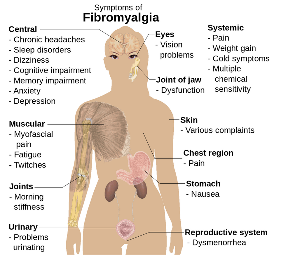 Diagram of symptoms of Fibromyalgia