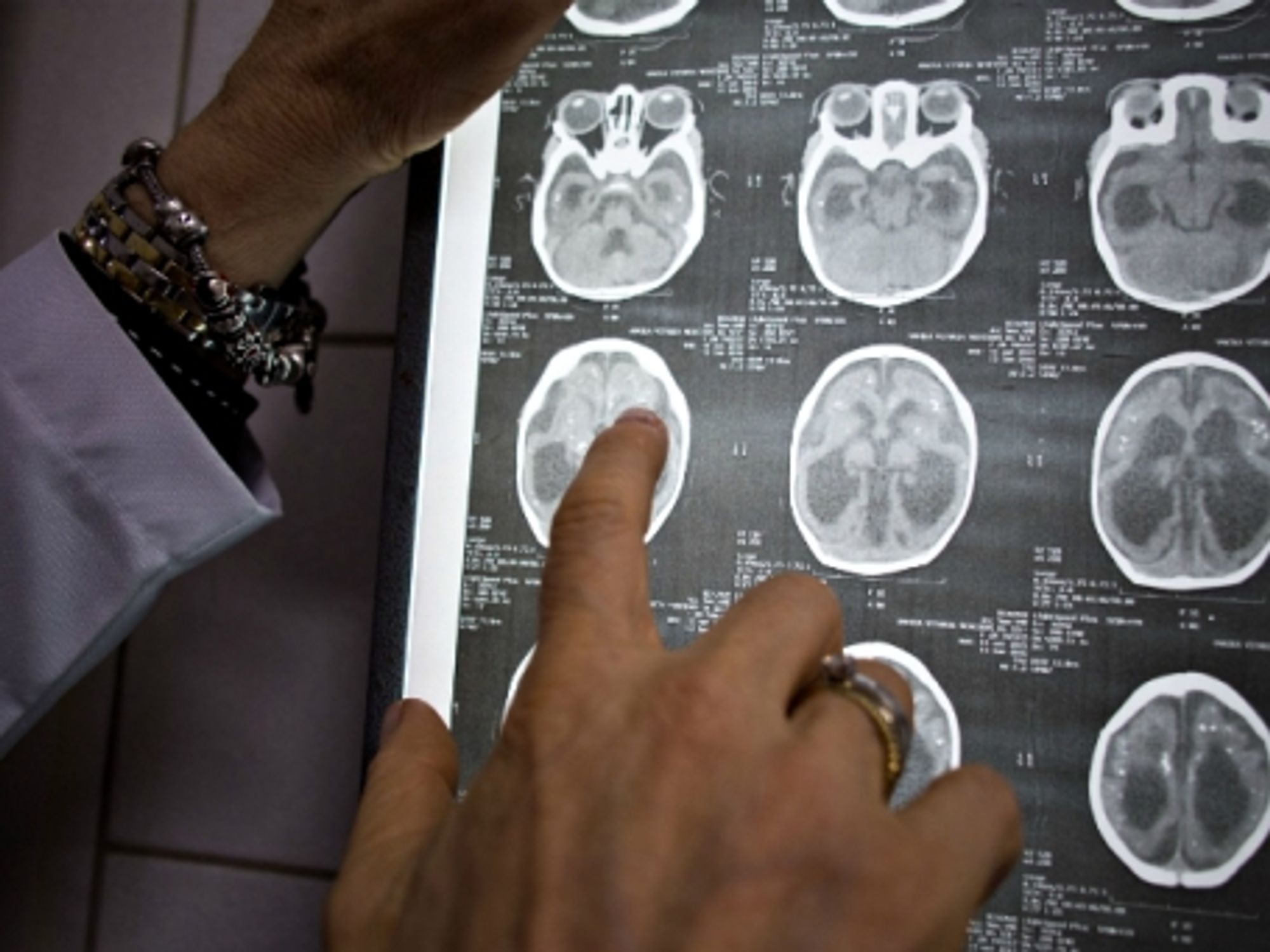 Doctor examining brain scans of a Zika-infected patient, in Recife, Brazil