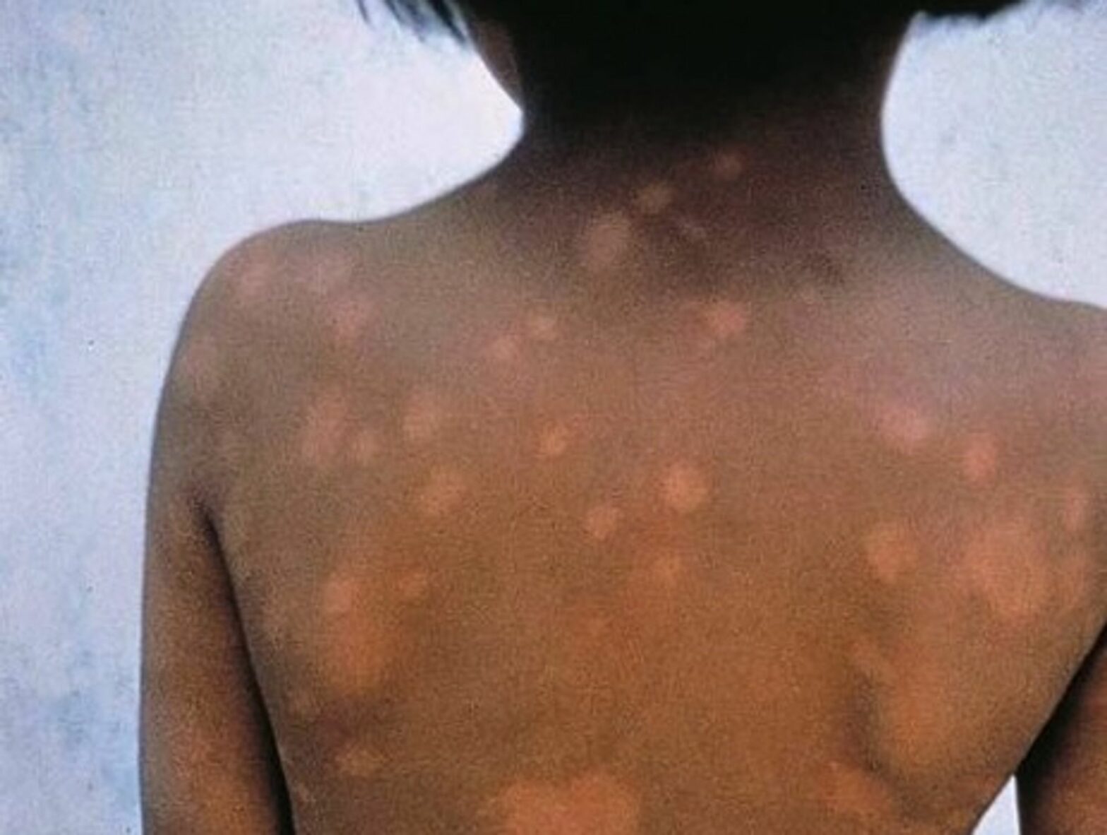 Leprosy in Argentina