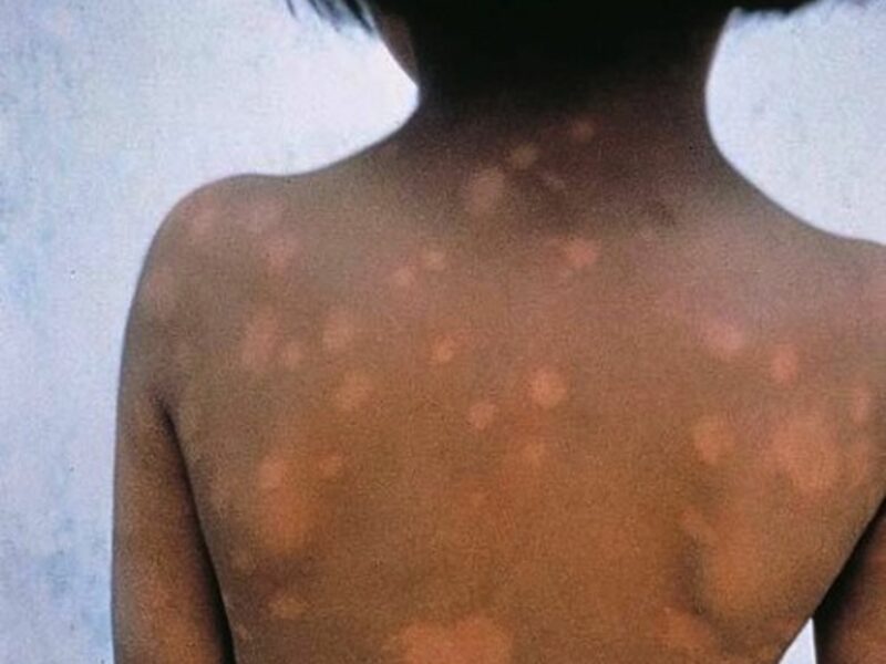 Leprosy in Argentina