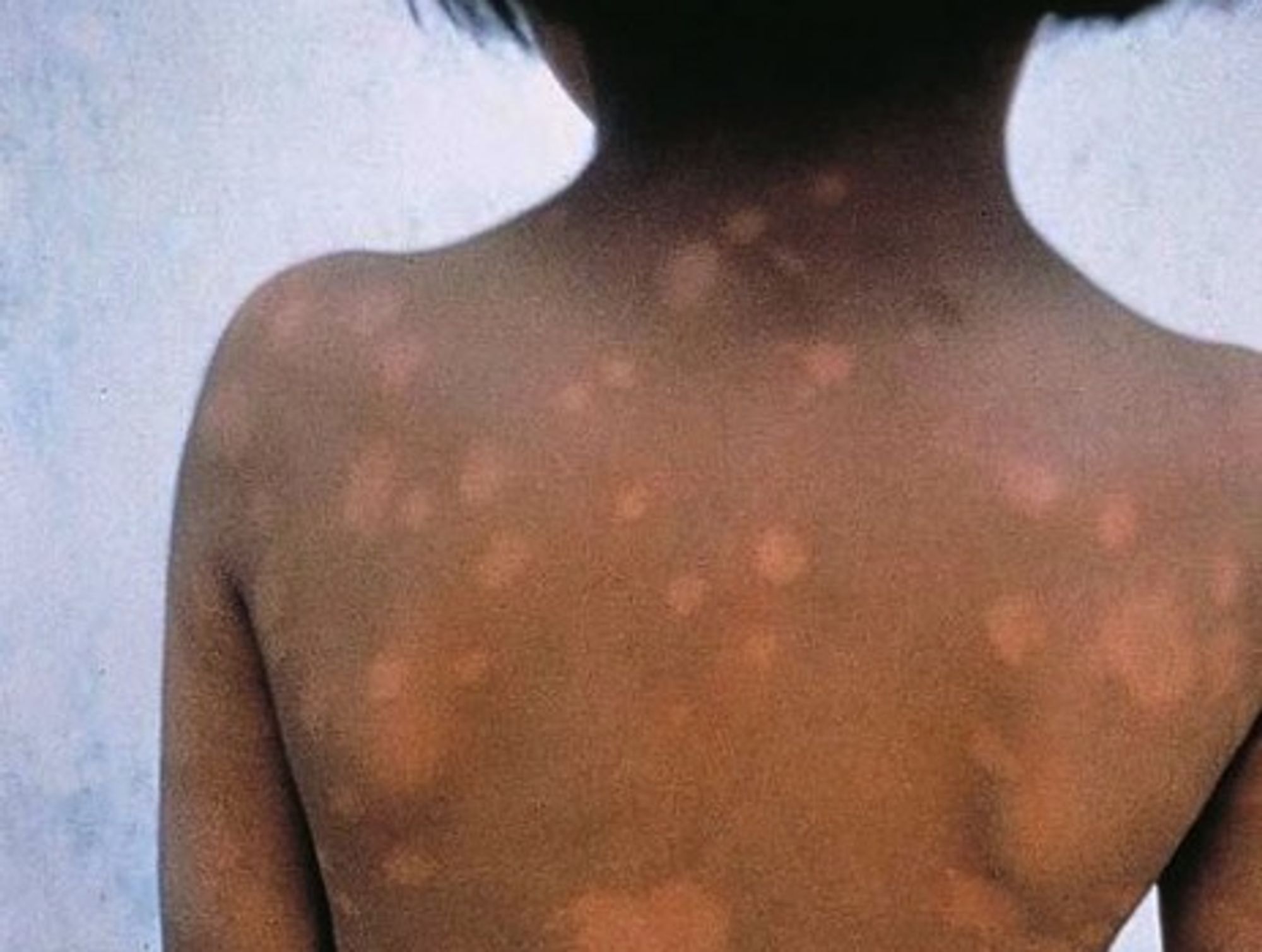 Leprosy in Argentina
