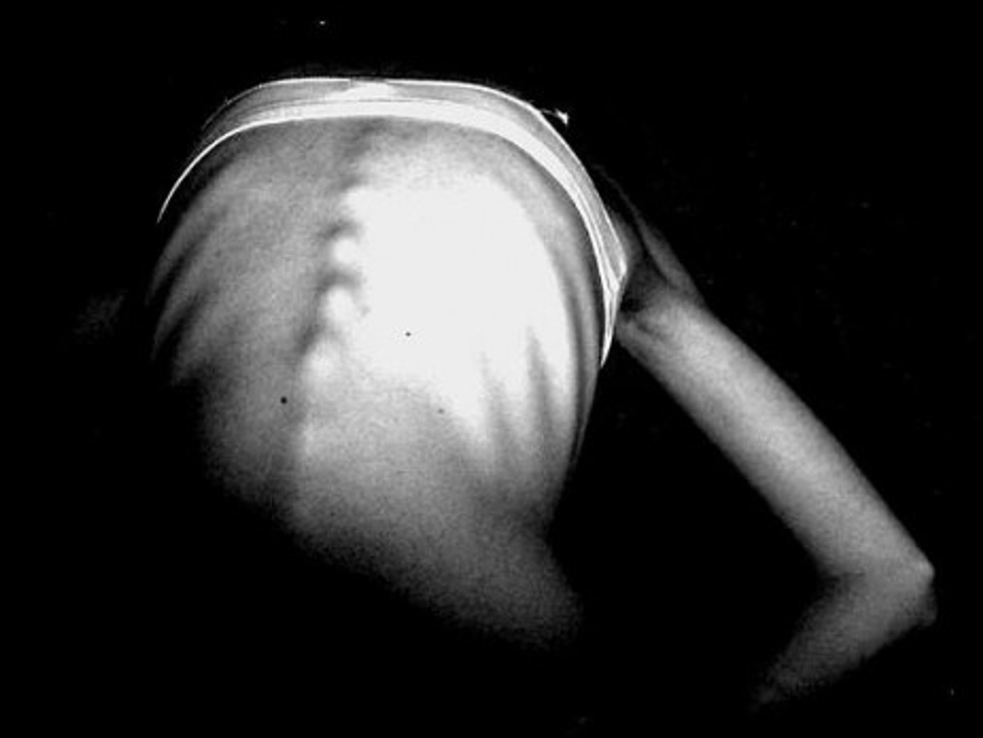 Medical Breakthrough: Genetics May Cause Anorexia, Other Forms Of Weight Loss