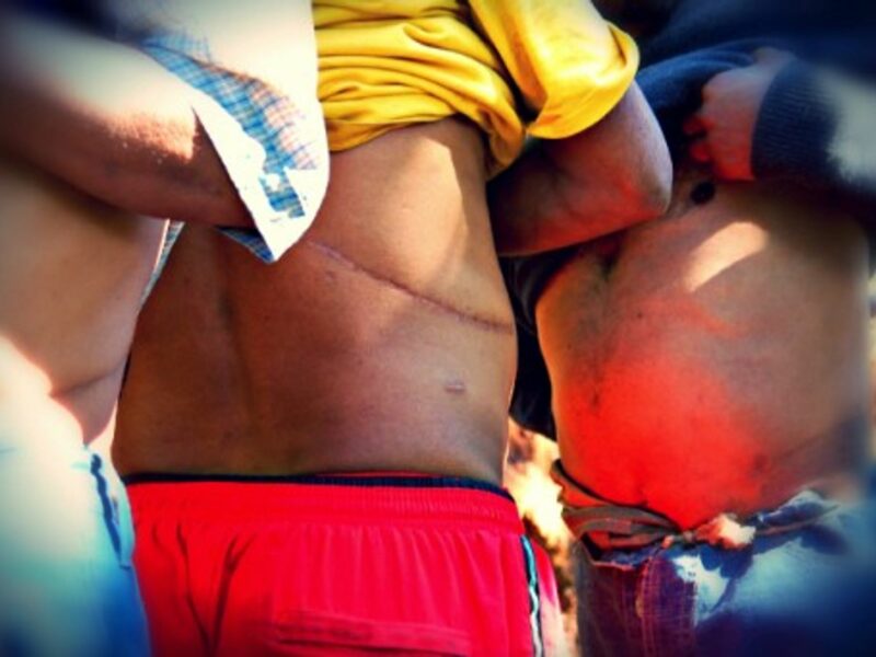 This 2007 image from Nepal's Cavre Valley, where it is said that in every family one person sold an organ for money.