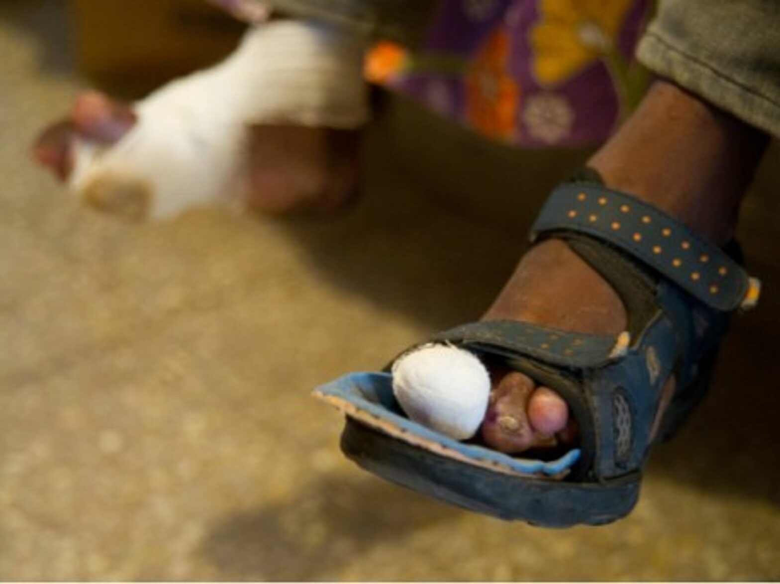 "Today, leprosy belongs in the category of neglected tropical diseases"