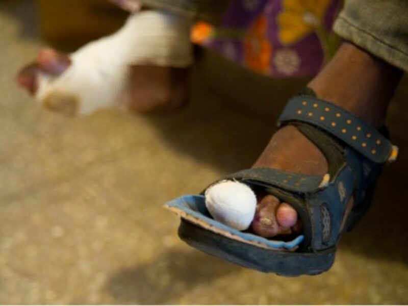 "Today, leprosy belongs in the category of neglected tropical diseases"