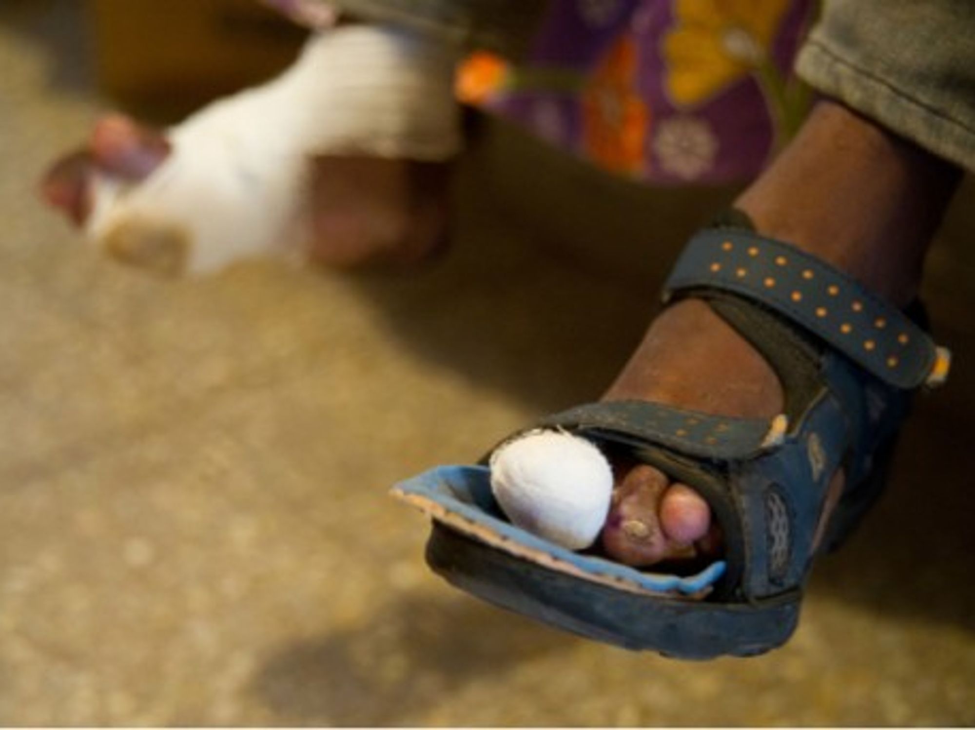 "Today, leprosy belongs in the category of neglected tropical diseases"
