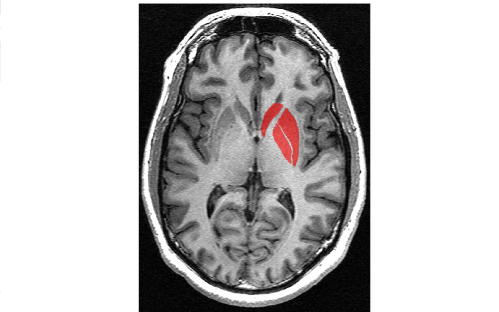 Transverse section of striatum from a structural MRI image