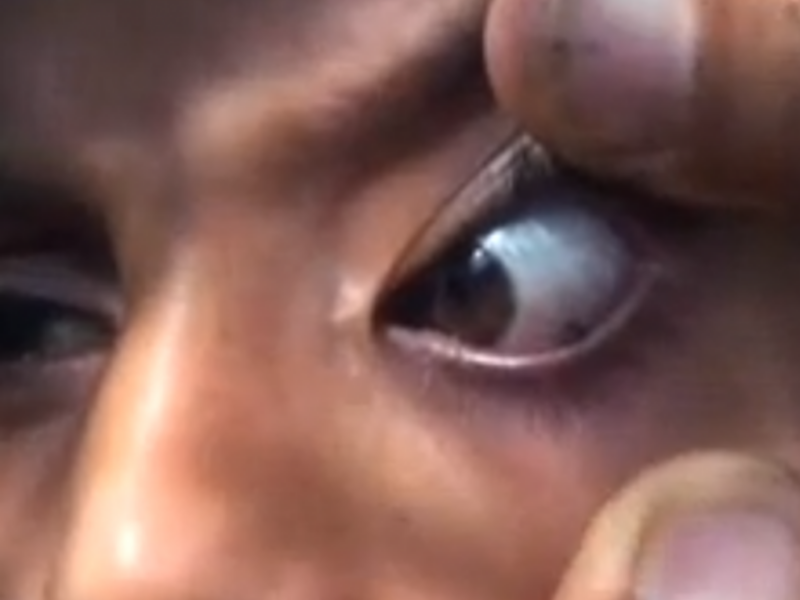 Video: Girl 'Cries Stones' in Yemen