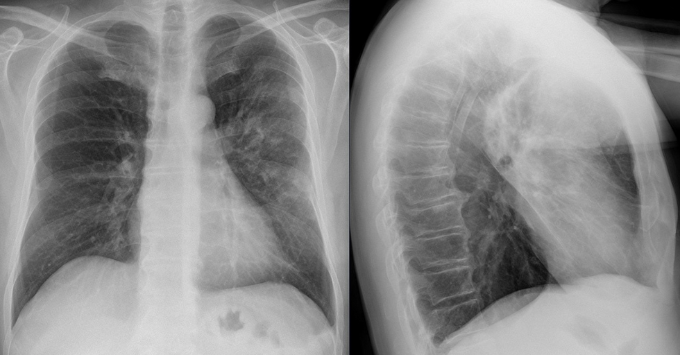 X-ray image of lungs affected by Legionnaires' disease-linked pneumonia