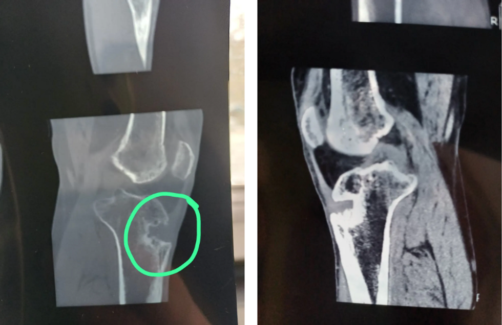 X-ray imagery showing wound-related holes in Mikhail's bones